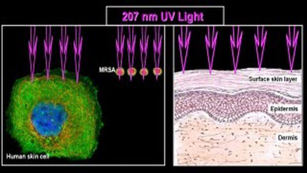 Narrow-Spectrum UV Light May Reduce Surgical Infections